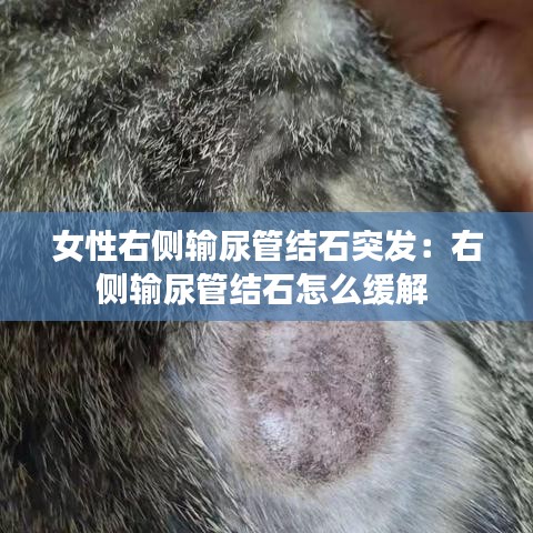 女性右側(cè)輸尿管結(jié)石突發(fā)：右側(cè)輸尿管結(jié)石怎么緩解 