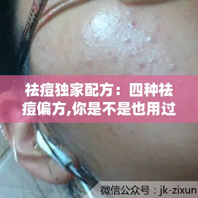 祛痘獨(dú)家配方：四種祛痘偏方,你是不是也用過 