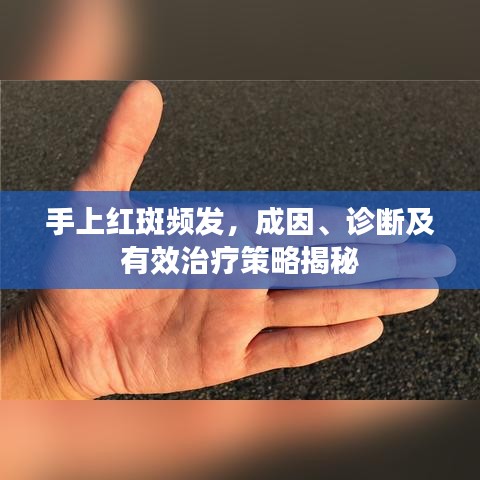 手上紅斑頻發(fā)，成因、診斷及有效治療策略揭秘