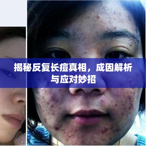 揭秘反復(fù)長痘真相，成因解析與應(yīng)對妙招