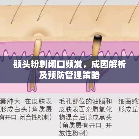 額頭粉刺閉口頻發(fā)，成因解析及預防管理策略